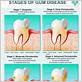 what to avoid if you have gum disease