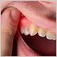 what to do for an inflamed gum