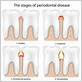 what to do for gum disease pain