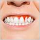 what to do if you have gingivitis