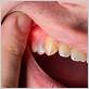 what to take for inflamed gums