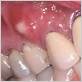 white bump from gum disease