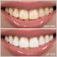 whitening stained teeth