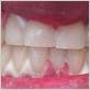 whitening strips gum disease