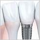 will dental implants help gum disease