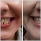 will getting dentures stop gum disease