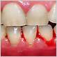 will goodby gum disease stop bleeding gums