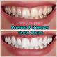will teeth whitening remove stains