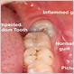 wisdom teeth causing gum disease