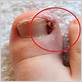 youtube dental floss ingrown toenail