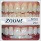 zoom teeth whitening gum disease